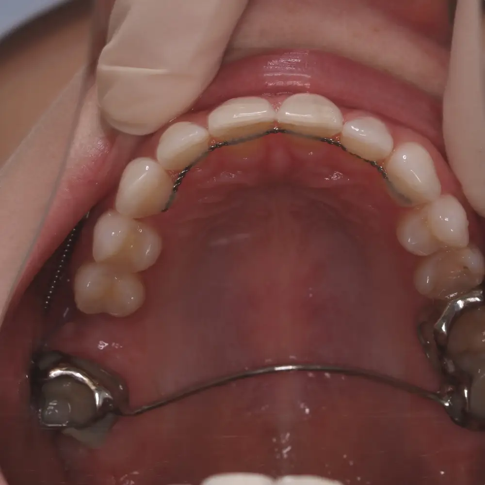 Kieferorthopädischer kontrollierter Lückenschluss mit MAS